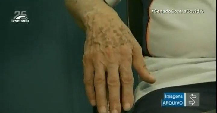 Vídeo: CAS aprova isenção de IR para aposentados com Alzheimer