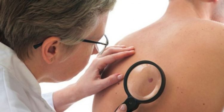 Audiência debaterá tratamento de câncer de pele pelo SUS